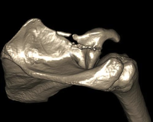 Coracoid Fracture CT 4